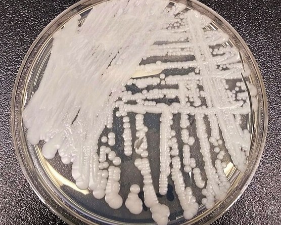The Silent Spread: Understanding Candida auris and Its Resistance Profile