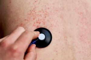 The Resurgence of Measles in 2025